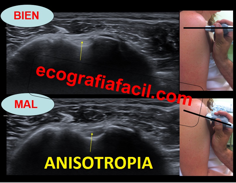 299. Anisotropía Tendón del Bíceps. – Ecografía Fácil