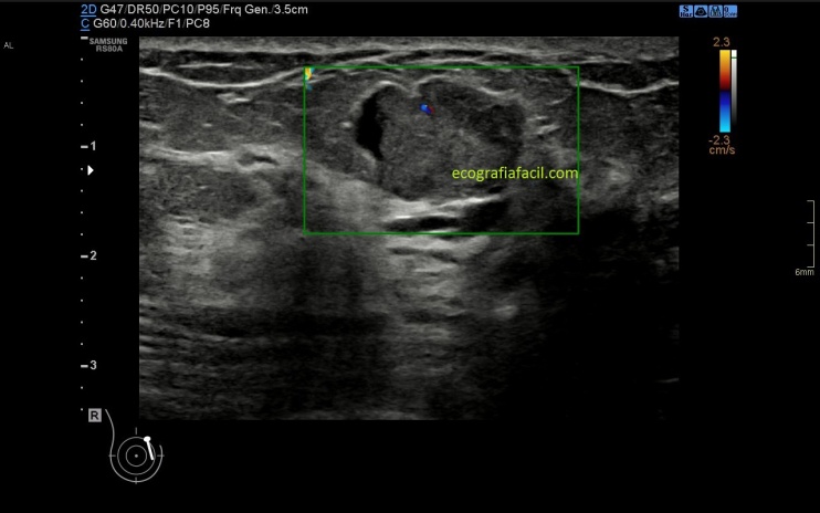Papiloma ductal ecografia. Solitary papilloma of larynx